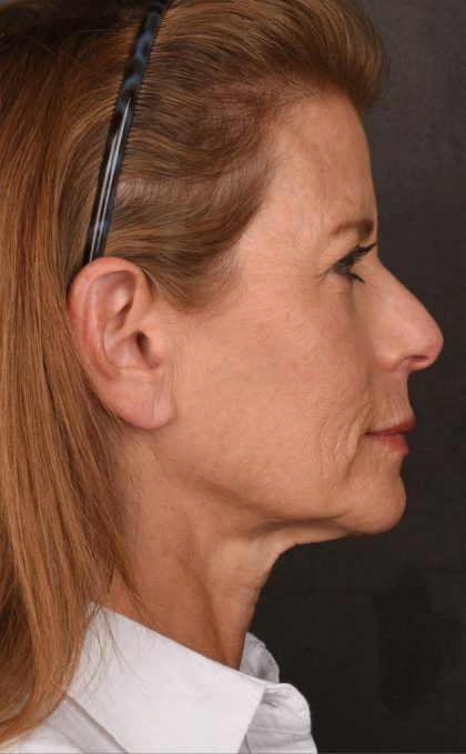 Facelift Before & After Patient #2868