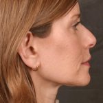 Facelift Before & After Patient #2868