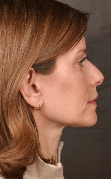 Facelift Before & After Patient #2868