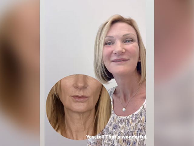 Testimonial: Facelift