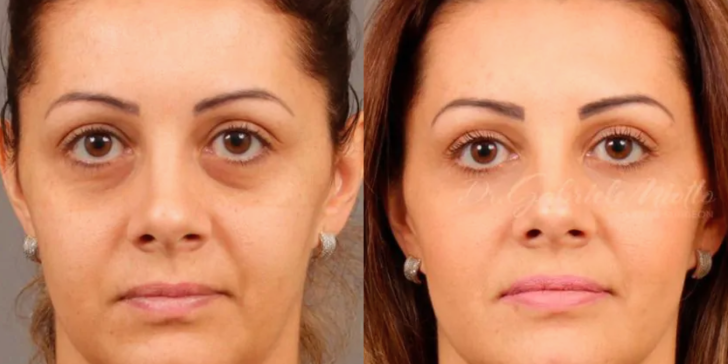 Dark Circles and Eyelid Bags