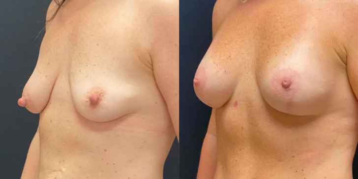 Breast Lift With Implants