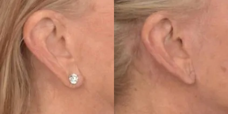 Earlobe Reduction