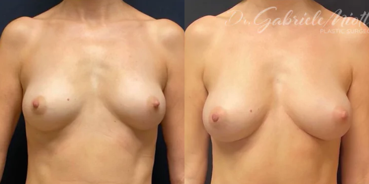 Fat Transfer Breast Augmentation