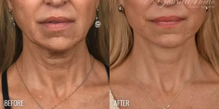 Neck Lift
