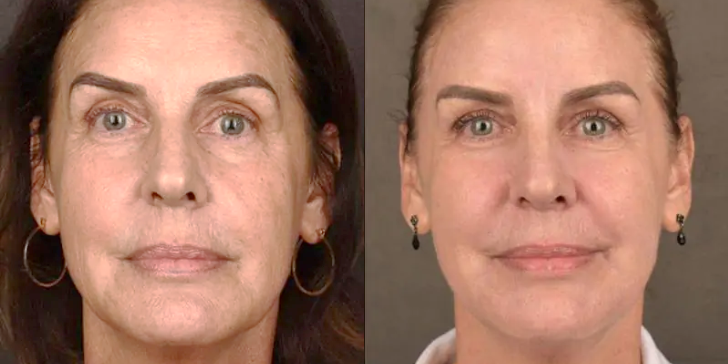 Skin Resurfacing