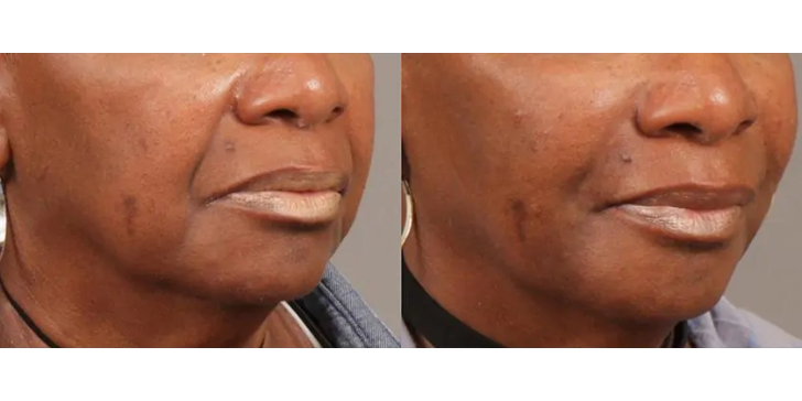 Softening of Facial Creases Wrinkles Before and After Photos Atlanta ...