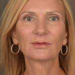 Facelift Before & After Patient #3452
