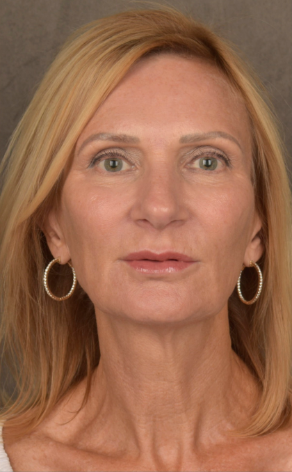 Facelift Before & After Patient #3452