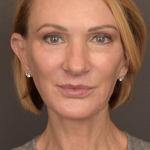Facelift Before & After Patient #3452