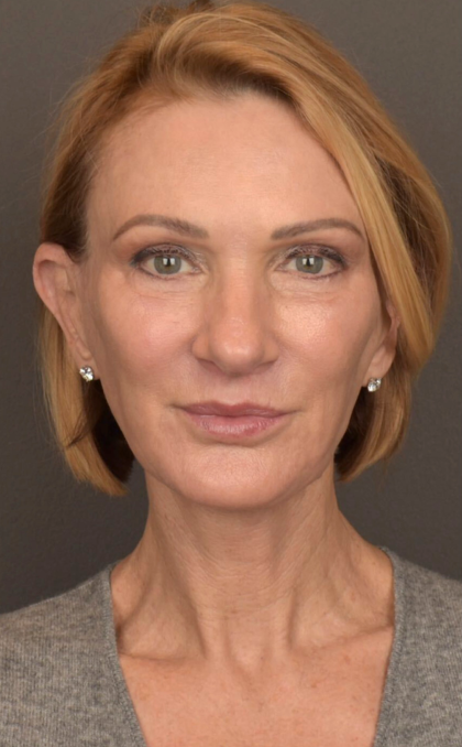 Facelift Before & After Patient #3452