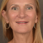 Facelift Before & After Patient #3452