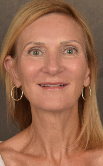 Facelift Before & After Patient #3452