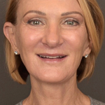Facelift Before & After Patient #3452