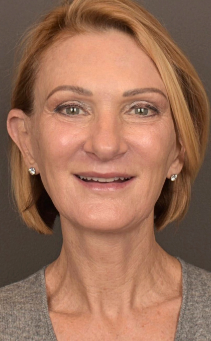 Facelift Before & After Patient #3452