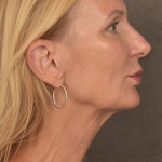 Facelift Before & After Patient #3452