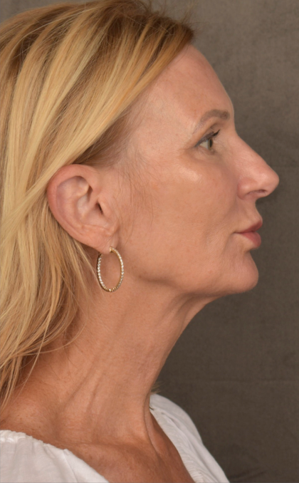 Facelift Before & After Patient #3452