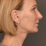 Facelift Before & After Patient #3452