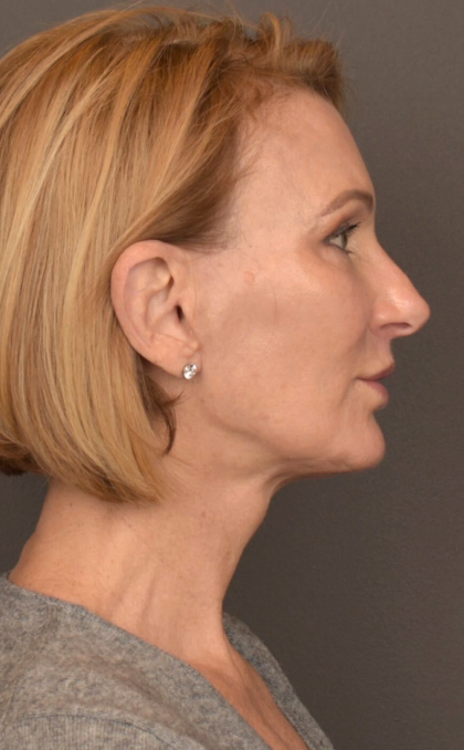 Facelift Before & After Patient #3452