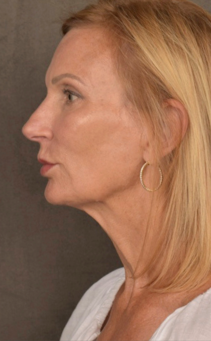 Facelift Before & After Patient #3452