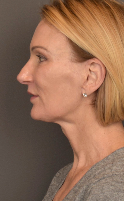 Facelift Before & After Patient #3452