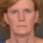 Facelift Before & After Patient #3460