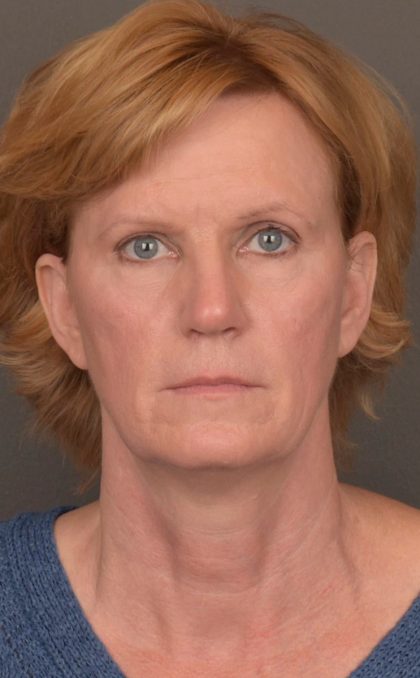 Facelift Before & After Patient #3460
