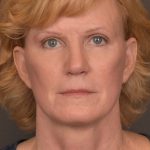 Facelift Before & After Patient #3460