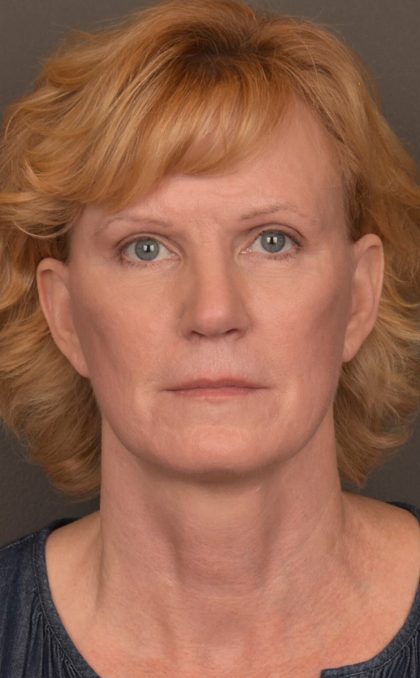 Facelift Before & After Patient #3460