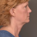 Facelift Before & After Patient #3460