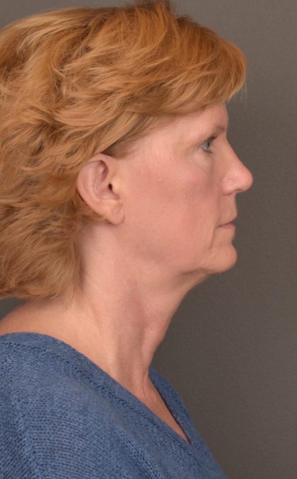 Facelift Before & After Patient #3460
