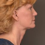 Facelift Before & After Patient #3460