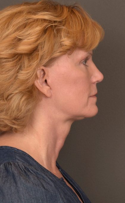 Facelift Before & After Patient #3460