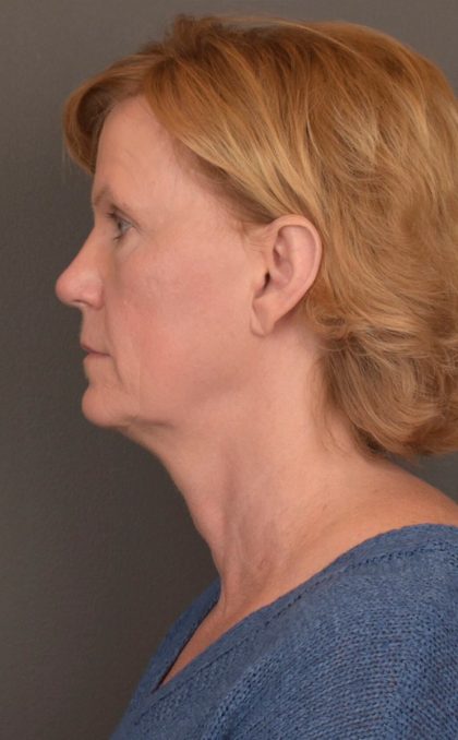 Facelift Before & After Patient #3460