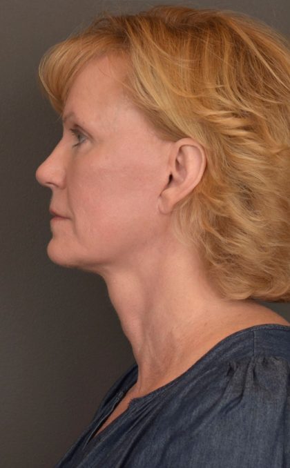 Facelift Before & After Patient #3460