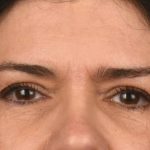 Blepharoplasty Before & After Patient #3270