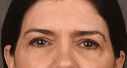 Blepharoplasty Before & After Patient #3270