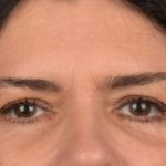 Blepharoplasty Before & After Patient #3270