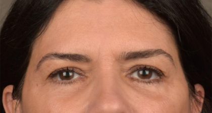 Blepharoplasty Before & After Patient #3270