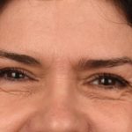 Blepharoplasty Before & After Patient #3270