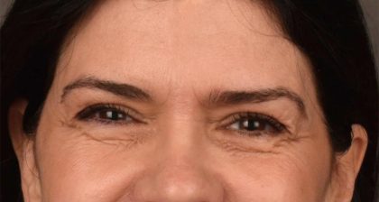 Blepharoplasty Before & After Patient #3270