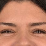 Blepharoplasty Before & After Patient #3270