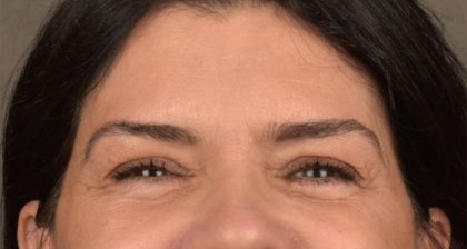 Blepharoplasty Before & After Patient #3270