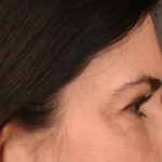Blepharoplasty Before & After Patient #3270
