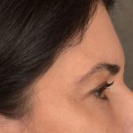 Blepharoplasty Before & After Patient #3270
