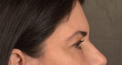 Blepharoplasty Before & After Patient #3270