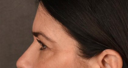 Blepharoplasty Before & After Patient #3270