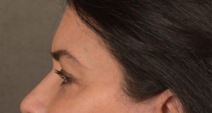 Blepharoplasty Before & After Patient #3270
