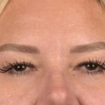Blepharoplasty Before & After Patient #3271