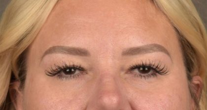 Blepharoplasty Before & After Patient #3271